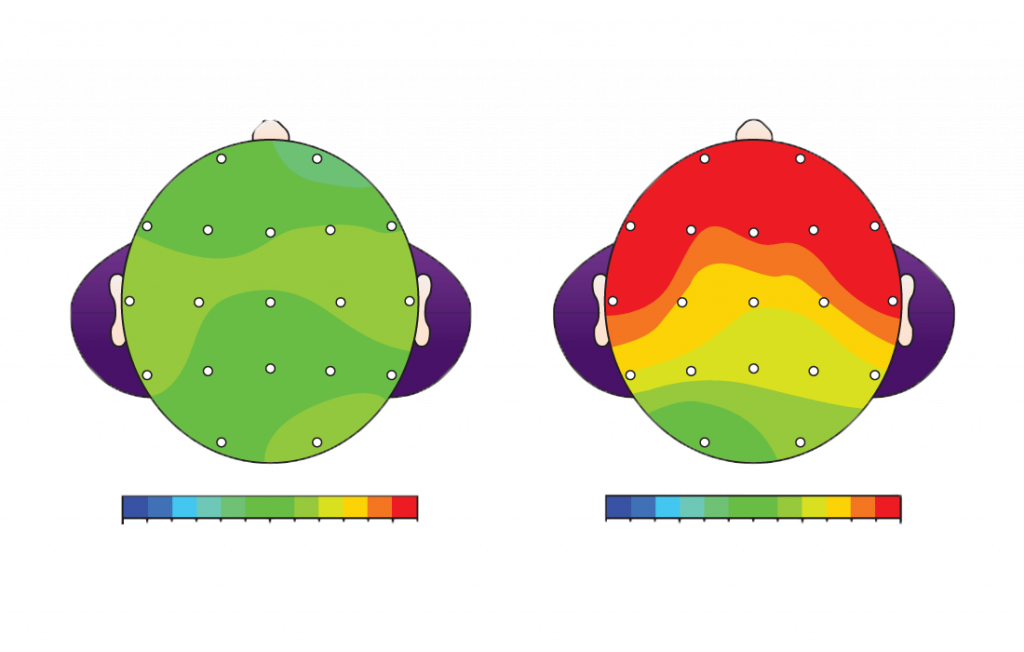 qeeg-neurofeedback-1